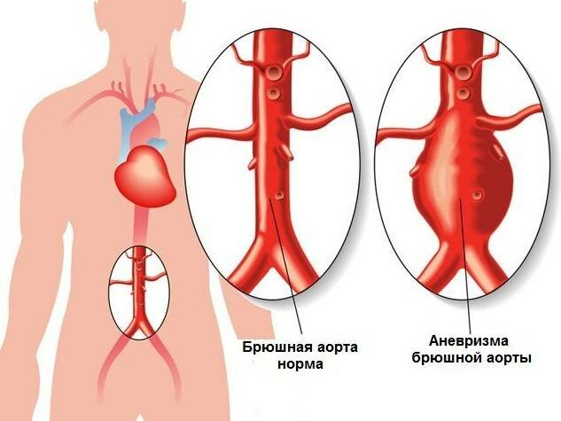 Аневризма аорты