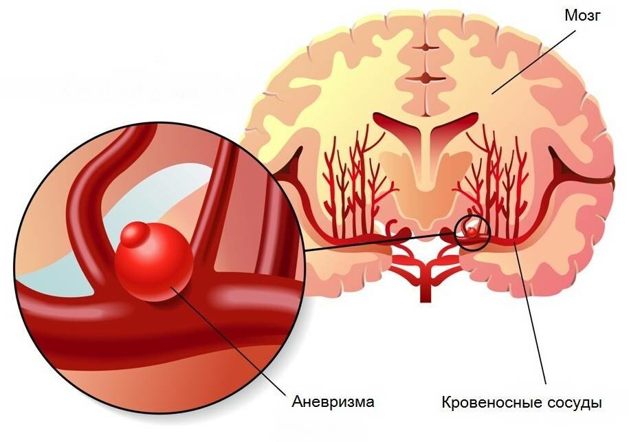 Аневризма головного мозга