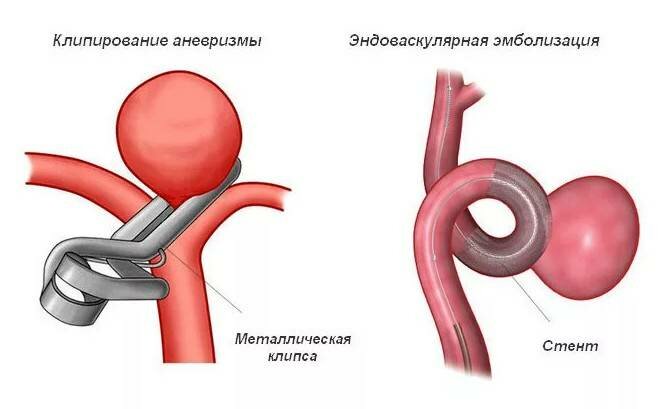 Хирургия аневризмы головного мозга