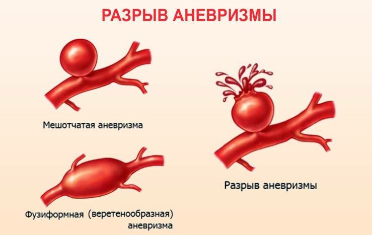 Разрыв аневризмы симптомы